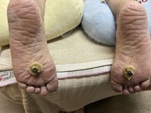 まゆ鍼灸院 岸和田 和泉/冷えにはニンニク灸