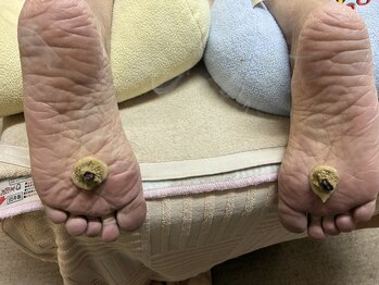 まゆ鍼灸院 岸和田 和泉/冷えにはニンニク灸