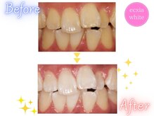 エクシアホワイトニング 京都駅前店/ホワイトニングビフォーアフター