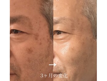 リジュベ(Rejuve)/コラーゲンマシン/シミ改善/髭