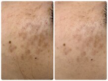 アンド ユー(and.yu)/40代/シミケア・美肌コース1回