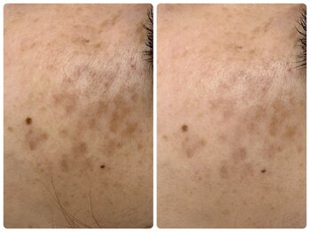 アンド ユー(and.yu)/40代/シミケア・美肌コース1回