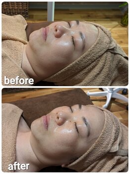 ウララ(ulala)/韓国ピーリング初回のビフォアフ