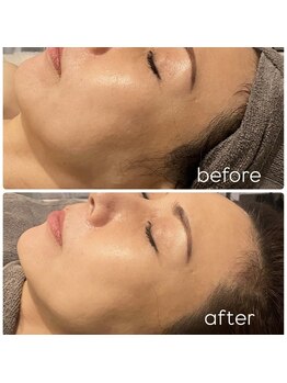 ラルミエール 緑店はなれ(la lumiere)/レモンボトル×コラーゲン糸