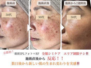 エソア(esoa)/50代 光フォト1回