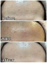 アズ(AZU)/繰り返しニキビに終止符！