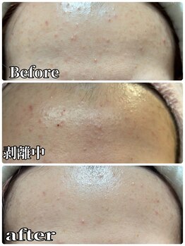 アズ(AZU)/繰り返しニキビに終止符!