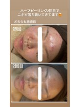 ココ(COCO)/2回目施術前でこんなにキレイに
