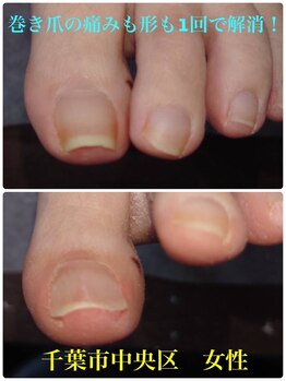 巻き爪じゅん 千葉駅前店/巻き爪の痛み改善で笑顔に！