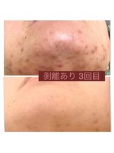 リリーグレース(Lily Grace)/ハーブピーリング(ハード)