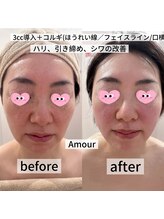 アムール(Amour)/レッドショット導入+コルギ
