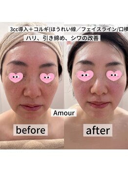 アムール(Amour)/レッドショット導入+コルギ