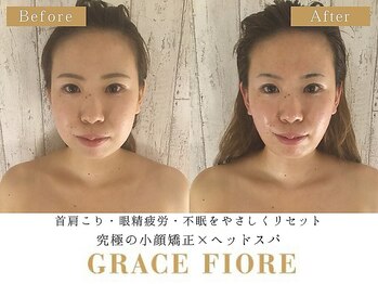 グレースフィオーレ 新宿店 (gracefiore)の写真/【新宿老舗店☆】頭蓋骨矯正+パイラナイト18000円→9,200円♪手技×EMS×ラジオ波の力で最大限の小顔に☆