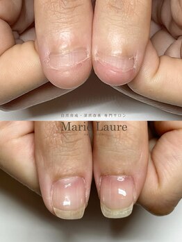 マリーロール 梅田店(Marie Laure)/自爪育成/深爪矯正/ネイルケア
