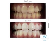 ホワイトニングショップ 新潟店/ホワイトニングビフォーアフター