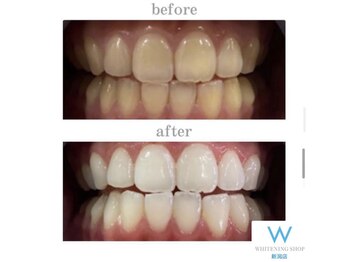 ホワイトニングショップ 新潟店/ホワイトニングビフォーアフター