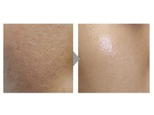 アンヴィウラ/光フェイシャル