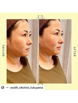ニコホリ(NIKOHORI)/エクソリフト/フェイシャル/美肌