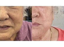 リジュベ(Rejuve)/コラーゲンマシン/冷え対策/髭脱