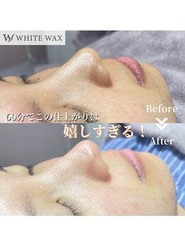 ホワイトワックス 浜松(WHITE WAX)/1回の施術で効果を実感！