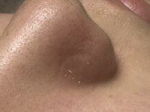 パールフェイスエステ ルペルル(PEARL FACE ESTHE la perle)/角栓除去