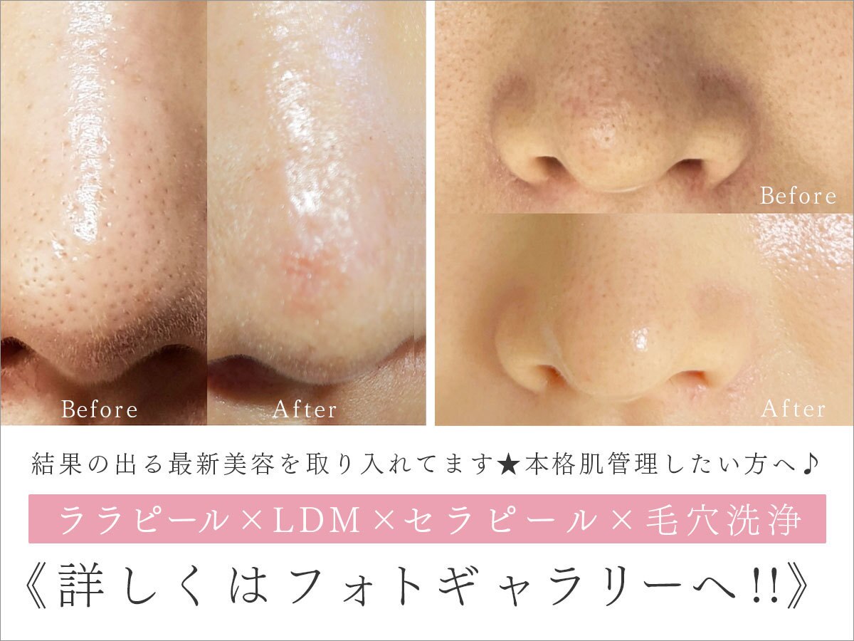 茅ヶ崎市で毛穴洗浄・毛穴吸引が人気のエステサロン