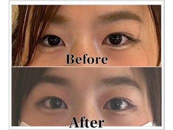 整体ラルース 中目黒(LALUZ)/20代 女性 二重整体 変化