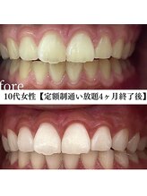 ホワイト 福岡天神店(WHITE)/ホワイトニングビフォーアフター
