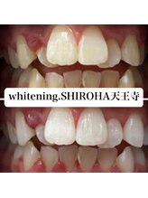 シロハ(SHIROHA)/セルフホワイトニング/天王寺