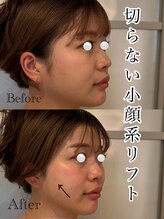 ティアラ(TIARA)/切らない小顔糸リフト