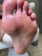 フットメンテ 巻き爪矯正センター 南浦和/魚の目