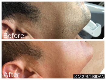 ビダン(BIDAN)/ヒゲ脱毛 BeforeAfter