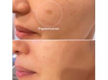 ルーメ(lume)/シミケア40代女性