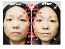 ビースマイル(Be-Smile)/ビフォーアフター写真