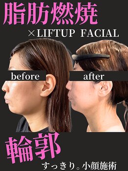 ノーブルノアール(Noble noir)/脂肪燃焼×小顔リフト☆★