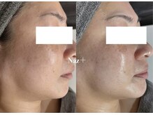 リベルテ(Liberte)/光フェイシャル