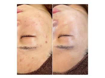 モア(moa)/ハーブピーリング6回