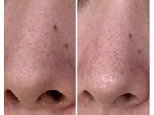 イル 名取店(iru)/毛穴洗浄フェイシャル