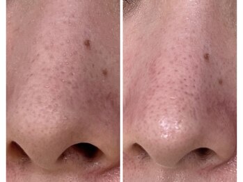 イル 名取店(iru)/毛穴洗浄フェイシャル