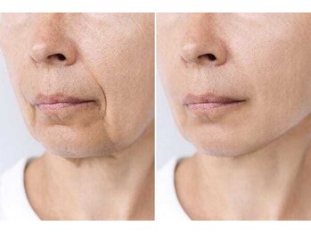 ティアレソワン(tiare soin)/口横のもたつき改善