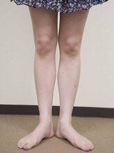 船橋カイロプラクティック/美脚矯正でO脚改善！！ 