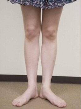 船橋カイロプラクティック/美脚矯正でO脚改善!!