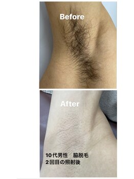 プレジール(PLAISIR)/メンズ脱毛 脇脱毛