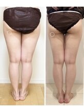 美人バスト つくば店/【ヒップアップ　症例】