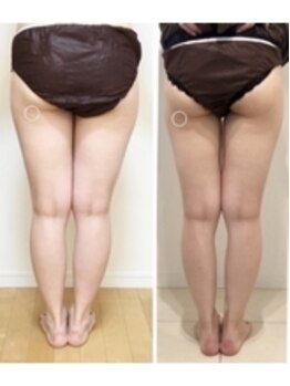 美人バスト つくば店/【ヒップアップ 症例】