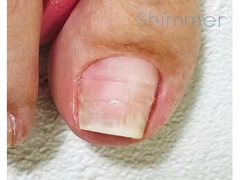 シマー(Shimmer)/内側に巻いた爪のお直し