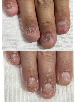 最強ネイルケアコース