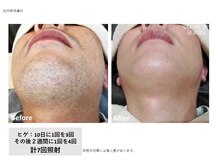 ラッシュ(RUSH)/約１年でヒゲ脱毛完了！