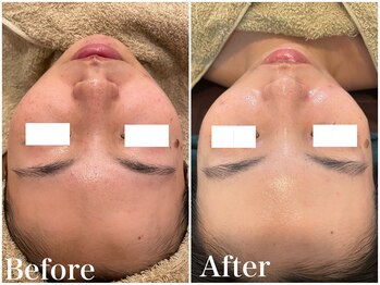 サロンドフェイス(Salon de Faith)/ハーブピーリング