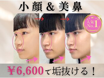 ラプリ 大宮店(Raplit)/隆鼻＋輪郭矯正40分30回